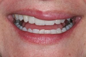 lowell dentist porcelain crown after photo